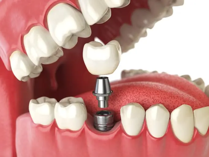 Where can I get Affordable Titanium/Zirconium Dental Implants in Mandurah?