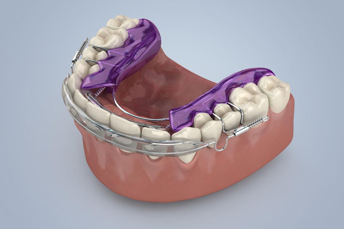 Porcelain Veneers