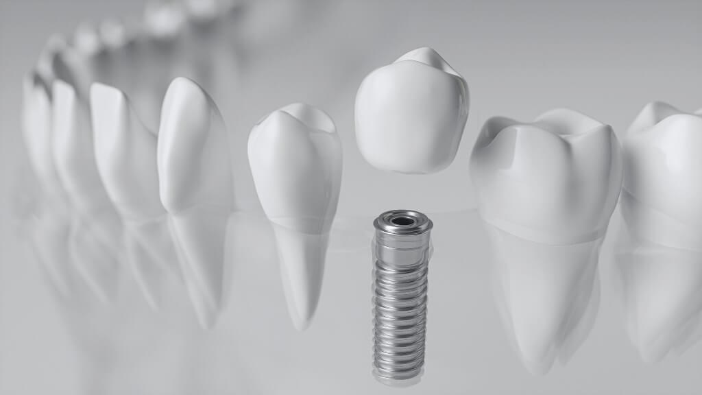 Dental implant components featuring a titanium post and several white ceramic crowns, illustrating the All-on-4 dental implant system materials.